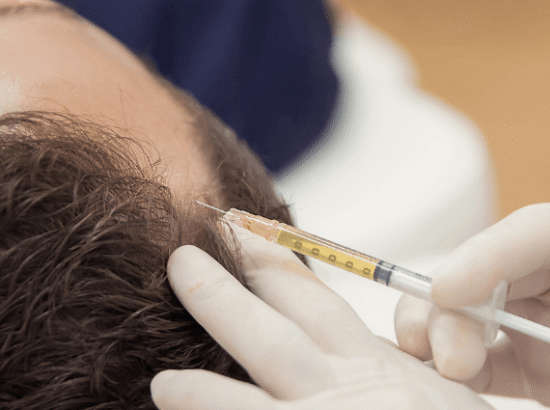 PRP HAIR RESTORATION