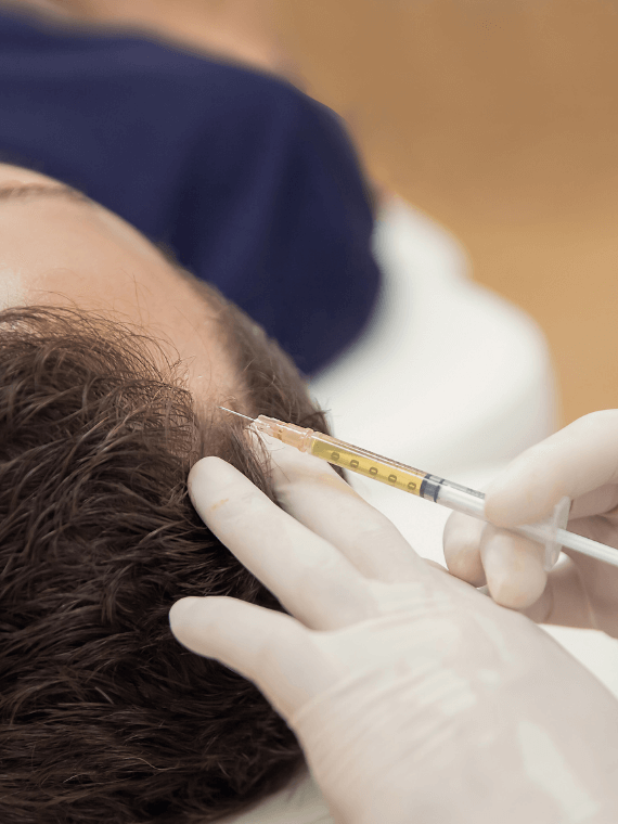 PRP HAIR RESTORATION